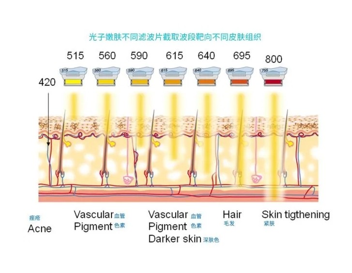 五大光子嫩膚技術(shù)（IPL、DPL、OPT、APT、BBL）及濾光片區別